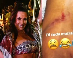 Scheila Carvalho mostra machucados após dançar em trio: “Metralhada“