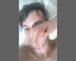 GO: “Sobrevivi”, diz jovem gay espancado e estuprado após Parada Gay 