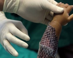 Pesquisadores cearenses oferecem doação de pele de tilápia ao Líbano
