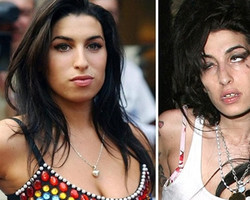 Antes e depois de celebridades após uso das drogas; imagens fortes
