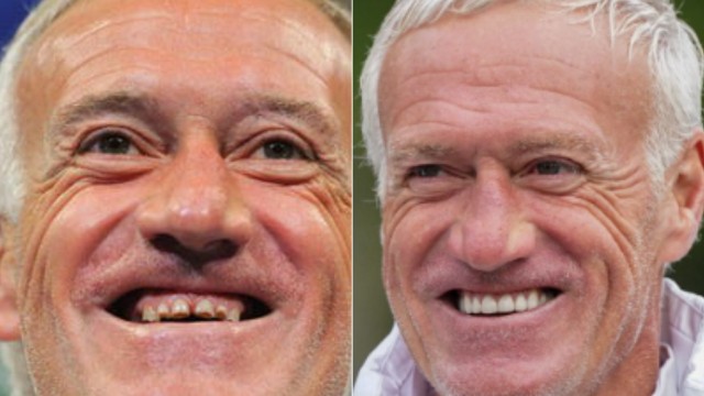 Didier Deschamps fez uma mudança nos dentes e está de sorriso novo - reprodução