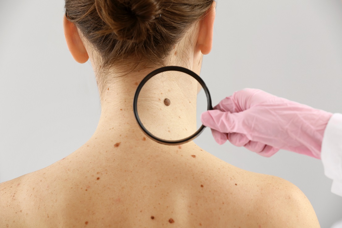 Atendimento do mutirão do câncer de pele acontece no Hospital Universitário - reprodução