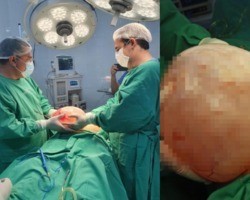 Médicos retiram “cisto gigante” de 5 kg de idosa no Sul do Piauí; fotos!