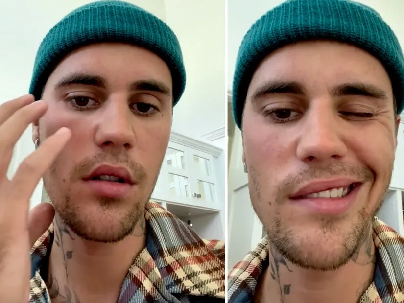 Justin Bieber mostra rosto paralisado e explica síndrome (Foto: Reprodução)