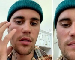 Justin Bieber fica com rosto paralisado; entenda a síndrome do cantor