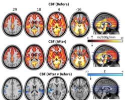  Depressão e dor de cabeça: psicodélico dos cogumelos pode mudar o cérebro?