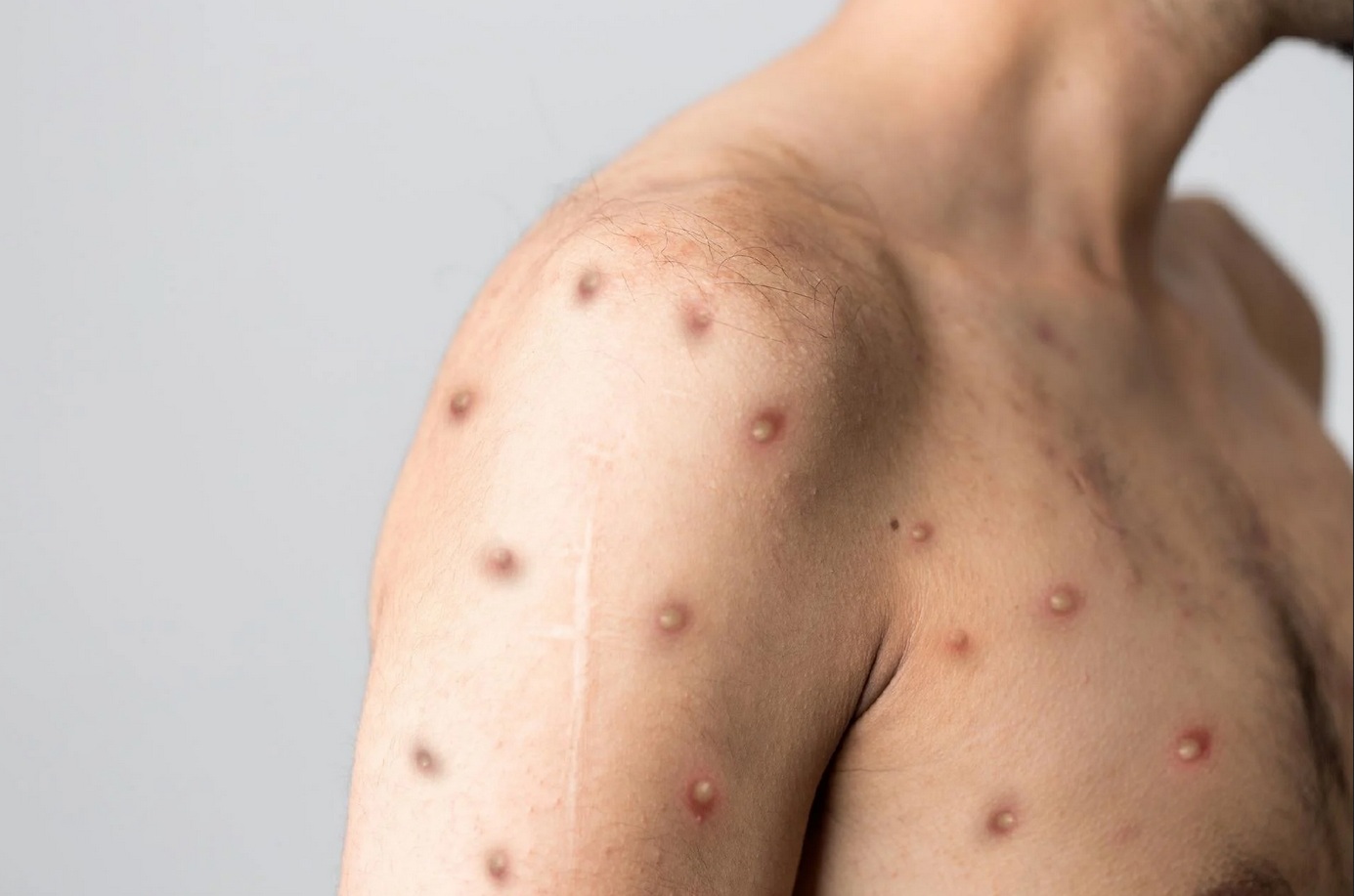 Um dos sintomas da varíola dos macacos são lesões na pele \ FOTO: Reprodução