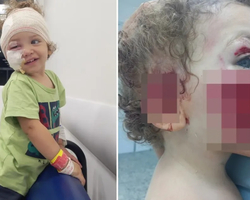 Criança tem parte do rosto rasgado após ser atacada pelo cachorro da babá